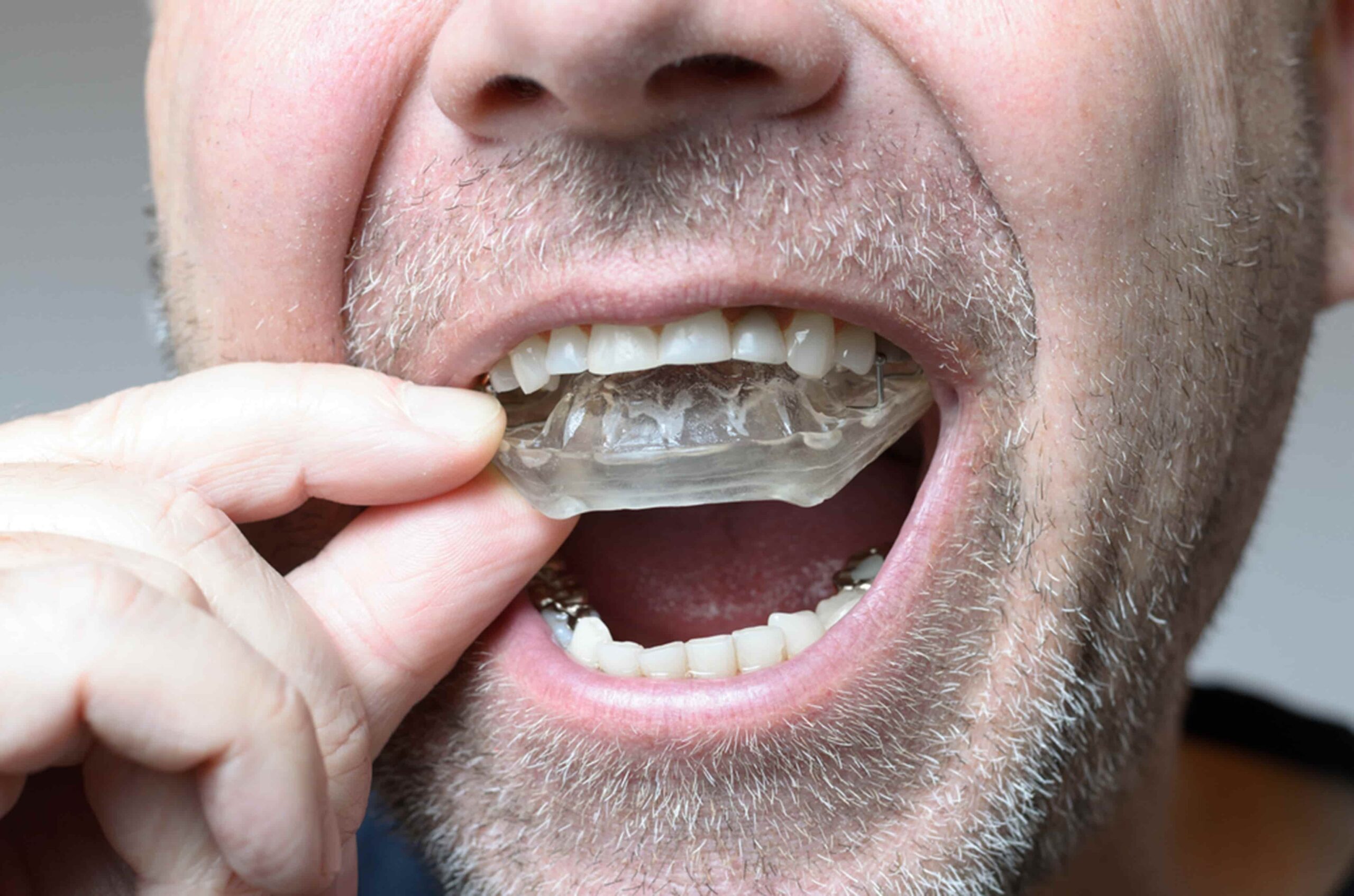 dental-appliances-min Dr. Peter Servinis
