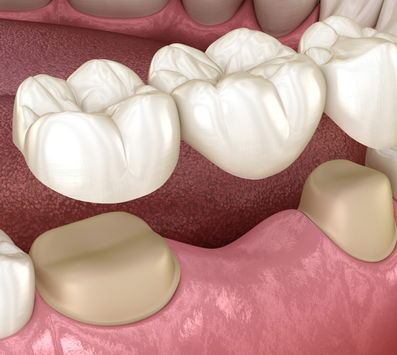 dental bridges in thunder bay