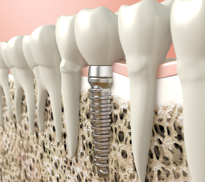 dental implants in thunder bay