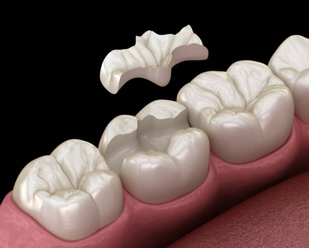 inlays-and-onlays-1 Dr. Peter Servinis