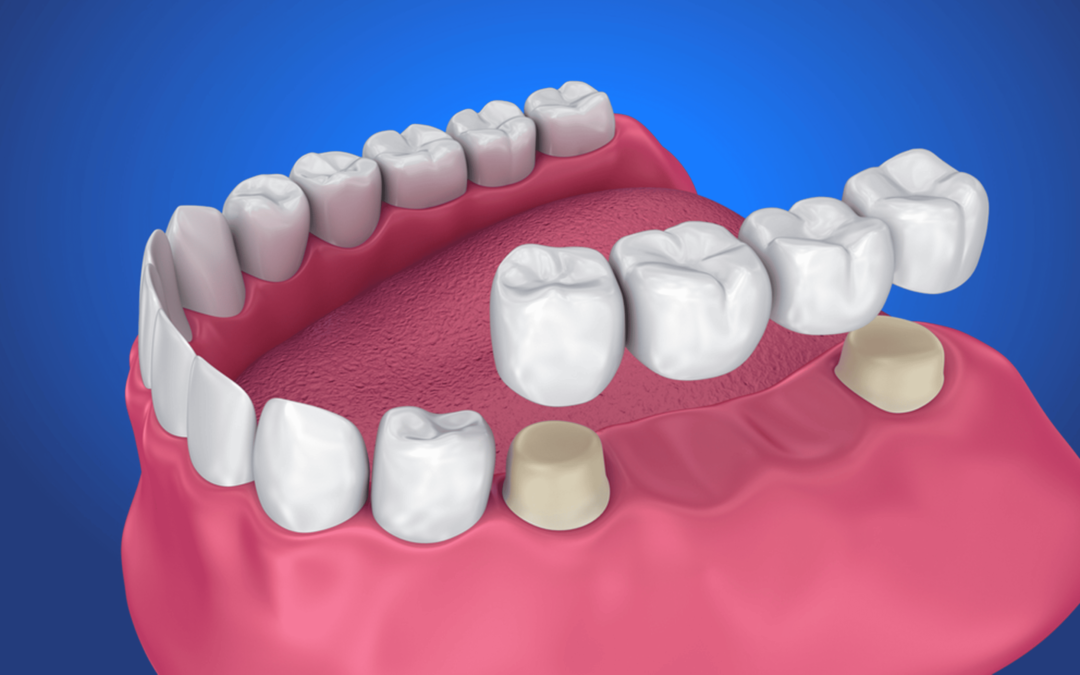 Dental Bridges: Everything You Should Know